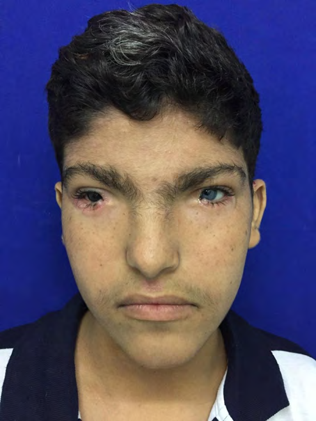 Figure 1: Hypertension, iris heterochromia, dystopia canthorum, enlarged nasal base and central white streak.