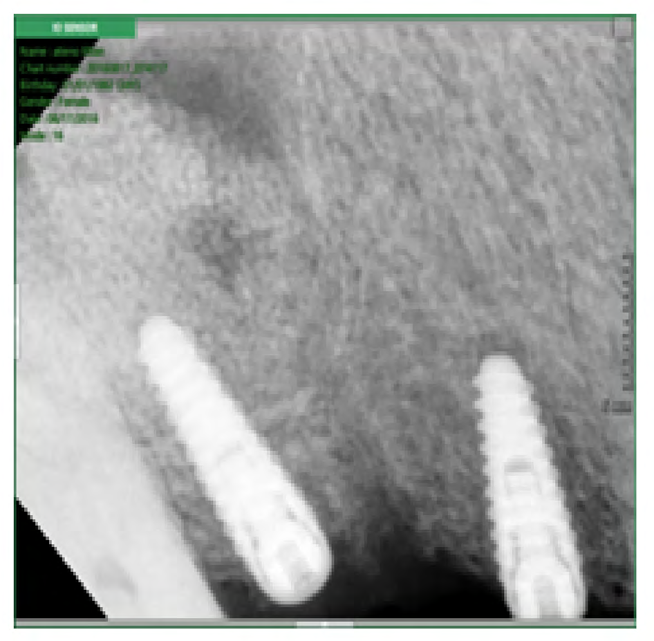 Figure 4: Patient 2 immediate post op x-ray.