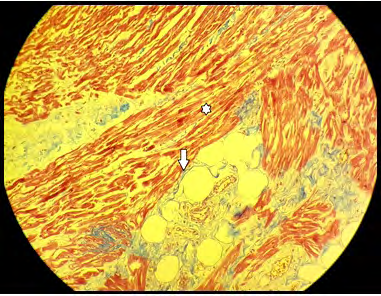 Figure 3: Fibro fatty replacement of the right ventricle myocardium at 20x magnification with Masson’s trichrome stain. The single-headed arrow points toward fibro fatty replacement. Asterisk marks the myocardium.