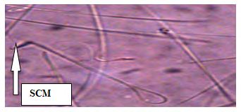 Figure 11: Plate IX: Semen smears from Group 7 (0.36mg/ kg bwt of Mesterolone Tablet for thirteen days) coiled tail (CT) (Eousin Negrosin stain × 400).