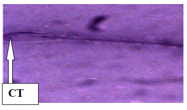Figure 9: Plate VII: Semen smears from Group 5(100mg/ Kgbwt of Ketoconazole Tablet for five days and 500mg/ Kg bwt of Ethanolic Extract of _Sesamum indicum_ seeds for thirteen days), Head (HA) and Mid Piece Abnormalitiesities (MPA) (Eousin- Negrosin stain × 400).