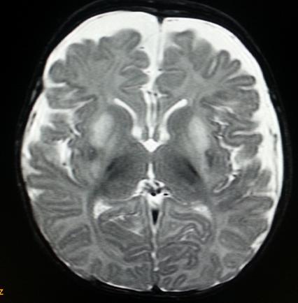 Figure 3: MRI Axial stir images at the level of basal ganglia showing diffuse abnormal hyperintensities of globuspallidus and putamen.