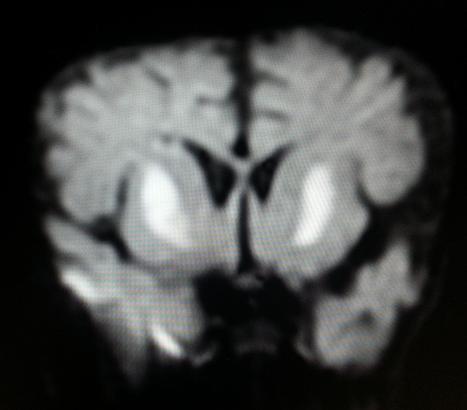 Figure 4: MRI Coronal diffusion weighted imaging at the level of basal ganglia showing homogenous restricted diffusion in bilateral basal ganglia.