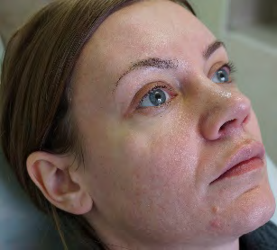 Figure 1: Patient T., female, 35 y.o.: before treatment