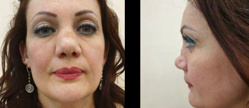 Figure 4: Patient T., female, 35 y.o.: after treatment completion.