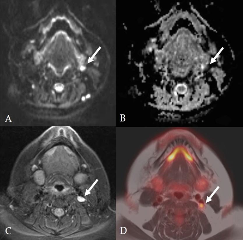 Figure 1: Diffusion-weighted image (A); Apparent coefficient map (B); axial T1-weighted image with gadolinium (C) and fused T1-weighted TSE and PET image (D). 1.1 x 0.7 cm lymph node at the left level 3 deep cervical chain that demonstrates abnormal metabolic activity, with an ADC mean value <1.2 × 10−3 mm2/s (0.713 <1.2 × 10−3 mm2/s), identified by white arrows.