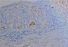 Figure 4: GCDFP-15 (gross cystic disease fluid protein), magnification 200x-Paget cells showed positivity for GCDFP-15 (also known BRST2, PIP-prolactin induced protein) (a photomicrograph taken from our cases).