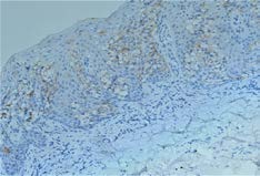 Figure 5: ERBB2 (also known HER2/neu – human epidermal growth factor receptor 2, c-erbB2, CD340), magnification 200x-Paget cells showed positivity for ERBB2 (HER2/neu) (a photomicrograph taken from our cases).