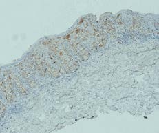 Figure 7: Melan-A (Melanoma Antigen), also called MART-1 (Melanoma Antigen Recognized by T cells 1), magnification 100x-Paget cells showed false positivity for Melan-A (a photomicrograph taken from our cases).