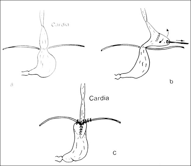 Figure 1: a) Hiatal Hernia, b) Stapling of fundus, c) Complete fundoplication.