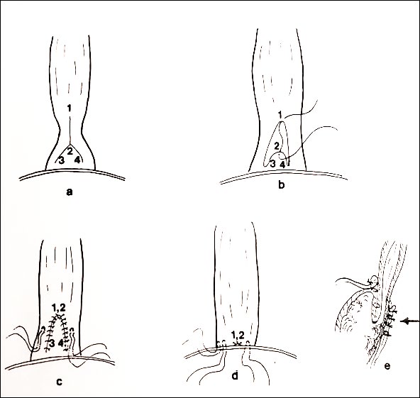 Figure 6: V-Y cardioplasty for recurrent achalasia.