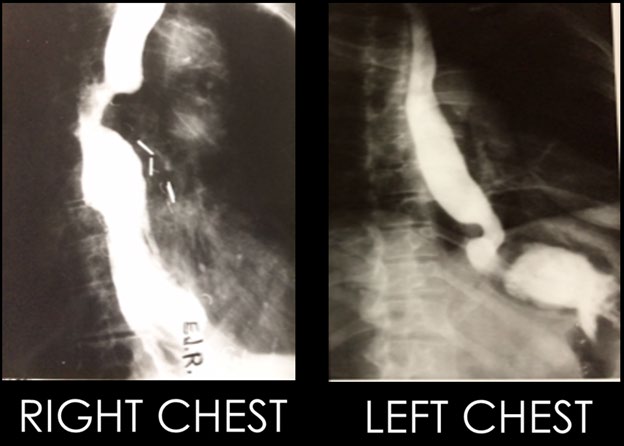 Figure 7: Postoperative esophagram a few days after right and left pedicle construction.