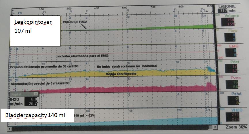 Figure 4: Urodynamic study showing a neurogenic bladder.