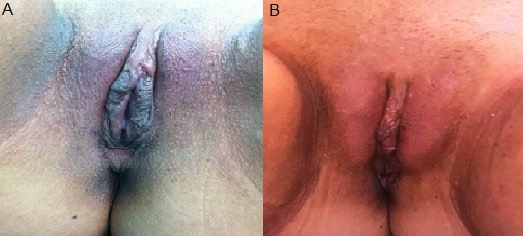Figure 2: A: Preoperative. B: 1- year Postoperative.