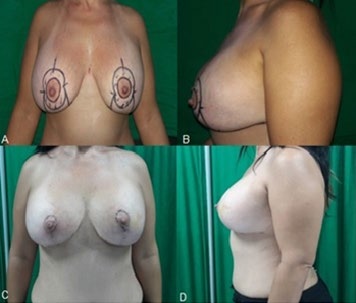 Figure 2: A: Preoperative - right oblique view. B: Preoperative - left oblique. C: Postoperative 6 months - right oblique view. D: Postoperative 6 months - left oblique view.