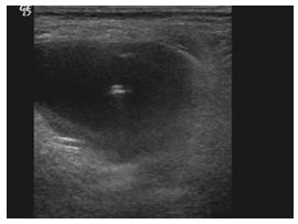 Figure 2: needle inside the aneurysm sac under US guidance Treated patients remained in bed for 2 h. Distal pulses were checked before and after the procedure. The patients had follow-up duplex ultrasound the day after and at four weeks following the procedure unless there was a clinical indication to perform this sooner.