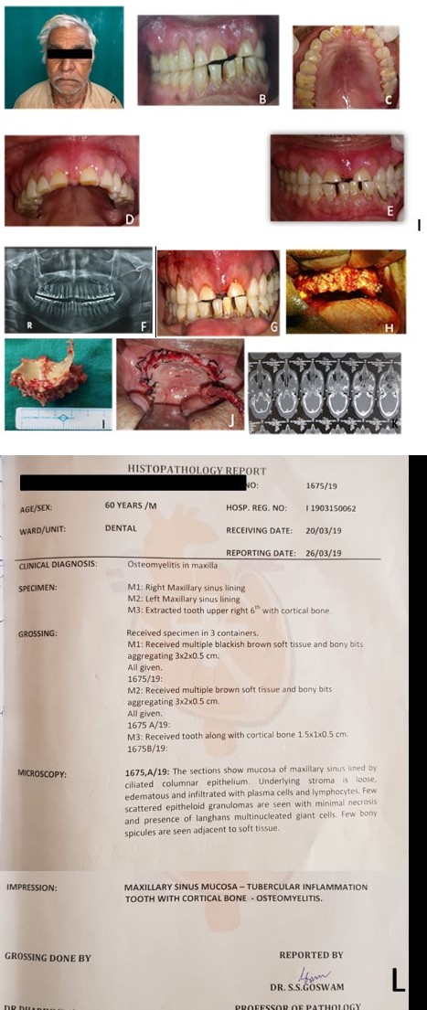 Figure 1: A) Extraoral image, B) Intraoral image during 1st visit, C) Occlusal view of maxillary arch at 1st visit, D) -Intraoral maxillary arch at 2nd visit, E) Intraoral view in maximum inter cuspation in 2nd visit F) Orthopantomograph, G) Pre-operative view , H) During maxillectomy, pus filled lobules were found I) Entire maxillectomy performed, J) Post-operative picture with flap placed back with single interrupted suture K) CECT scan. L) Histopathology Report.