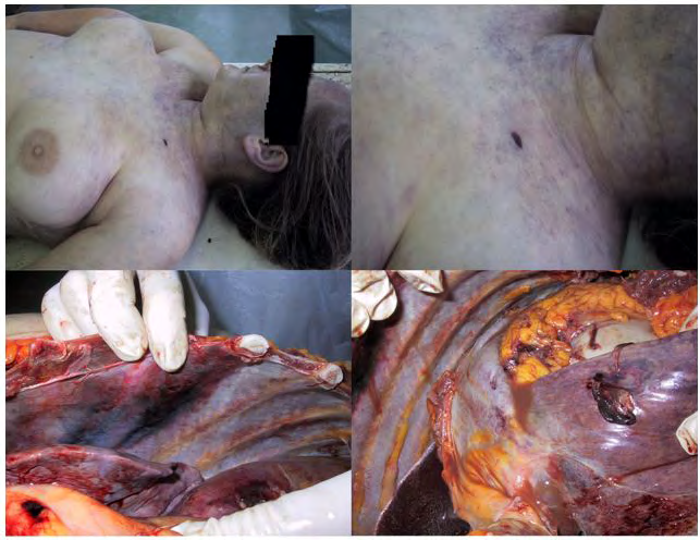 Figure 2: Transversal colon that was surrounded by necrotic tissue.