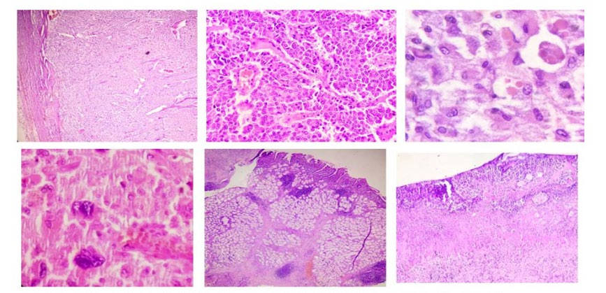 Figure 5: A Well encapsulated lesion with nests of tumor cells separated by fibrovascular septae(Zallballen pattern).(scanner view), B. Round to oval tumor cells with mild pleomorhism, stippled chromatin, moderate to abundant granular eosinophilic cytoplasm with indistinct cell borders. (High power view). C. Tumor cells with intracytoplasmic hyaline globules (High power view). D. Another field showing bizzare tumor gaint cells. E-F. Fragment of duodenal mucosa showing denudation of epithelium, lamina propria showing marked chronic inflammatory infiltrate(lymphocytes and plasma cells).
