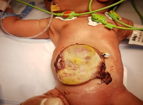 Figure 1: Omphalocele during operation.