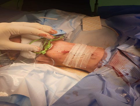 Figure 2: Omphalocele after reduction.