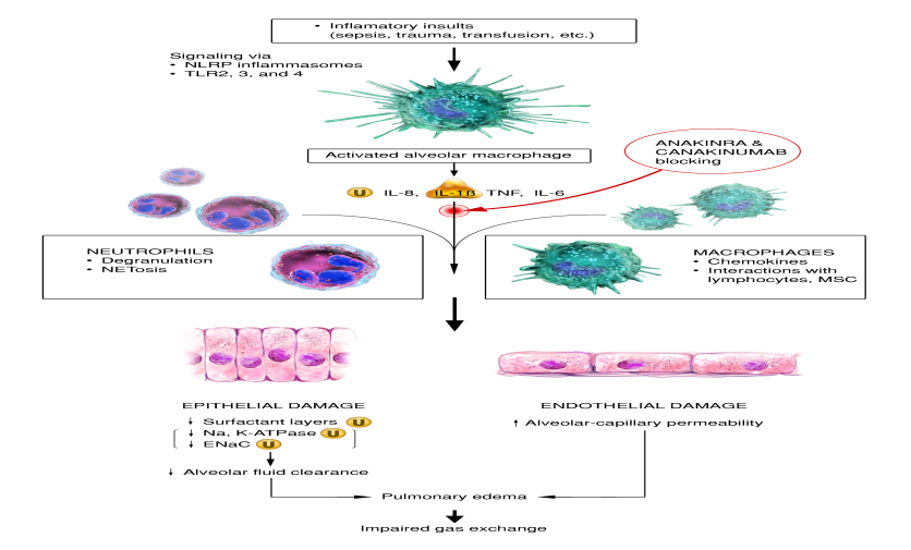 Figure 1: Initial inflammatory insults, including mitochondrial DAMPs, activate alveolar macrophages via TLR and NLR signaling pathways. Activated alveolar macrophages release proinflammatory cytokines and recruit circulating macrophages and neutrophils to injured sites. Excessive neutrophils and persistently activated macrophages cause extensive damage to lung epithelia and endothelia, resulting in an impaired alveolar–capillary barrier. Disruption of this barrier allows protein-rich fluid to enter the alveoli, causing fluid accumulation in alveolar spaces (pulmonary edema) that interferes with gas exchange.