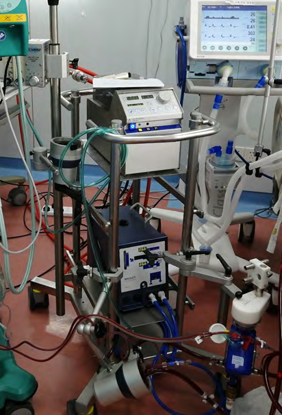 Figure 1: ECMO.