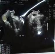 Figure 1: Imaging of the patients. (A) Detection of the intrauterine device (IUD) by plain abdomintal x-ray radiography, the IUDs is seen outside the uterine cavity. (B) Transvaginal ultrasound indicated the IUD was not seen in the uterine cavity. (C) Uansabdominal ultrasound examination revealed an anteflection uterus size 7x3x6 cm, right ovary size 2x2 cm, left ovary size 2x3cm, the IUD was not seen in the uterine cavity.