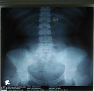 Figure 2: Intraoperative techniques. (A) The intrauterine device was in intraabdominal at posterior part of uterus. (B) The intrauterine device was removed.