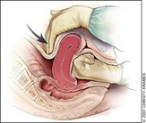 Figure 1: The posterior aspect of the uterus is massaged with the abdominal hand and the anterior aspect with the vaginal hand.
