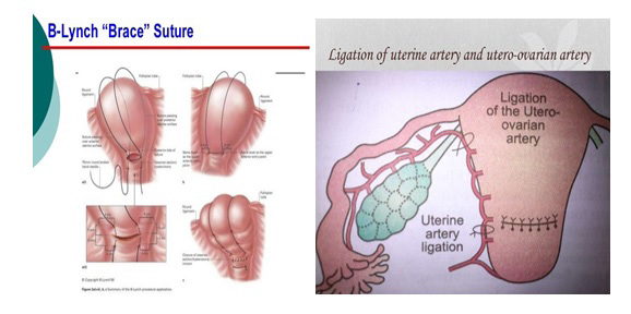 Figure 4: B-lynch Brace Suture. Ligation of uterine artery and utero-ovarian artery.