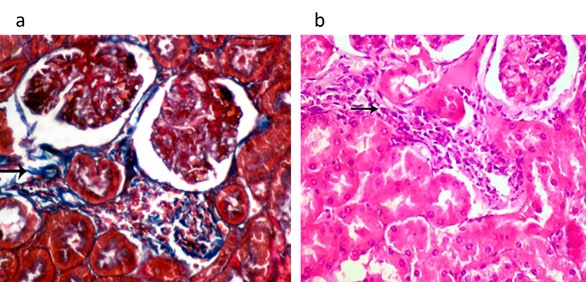 Figure 4: Kidney of lactating dams treated with the combined doses (1/20 LD50 of COC and 1/20 LD50 of CFP) orally from 0th - 21th days postpartum showing marked periglomerular and interstitial bluish stained fibrous tissue (arrow) in the renal tissue (MT, 400x). (b) Kidney of suckling pups of treated dams with the combined doses (1/20 LD50 of COC and 1/20 LD50 of CFP) orally from 0th-21th days postpartum showing lymphocytic and histiocytic infiltration in interstitial renal tissue (arrow) (HE, 400x).