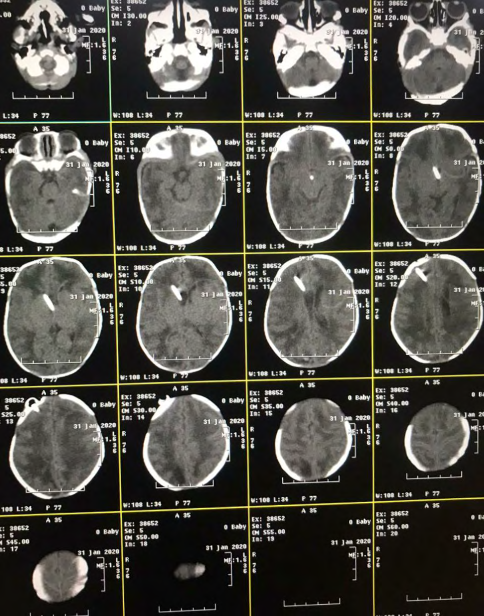 Figure 1: Ct Brain Showing Vp Shunt in Situ.