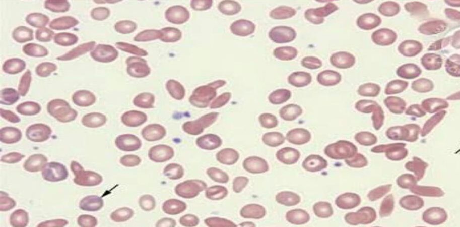 Figure 1: Blood Film Showing Sickle Cell and Target Cells 10X.