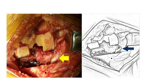 Figure 1: Popliteal tendon injury ( yellow arrow) during knee flexion after posterior condylar bone cut in high-flex prothesis design.