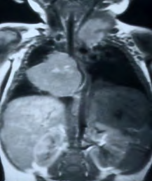 Figure 1: A: Thoracic neuroblastoma; B: Left adrenal neuroblastoma; C:MIBG scintigraphy shows with spinal cord compression in MRI multiple bone metastases