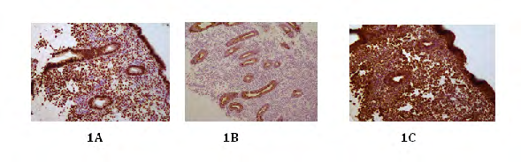 Figure 1: Immunohistochemistry examples from across the data set were satisfactory. 1A is progesterone receptor, 1B EMA and 1C vimentin demonstrating nuclear, membranous and cytoplasmic reactivity respectively. Photomicrographs taken at x10 magnification.
