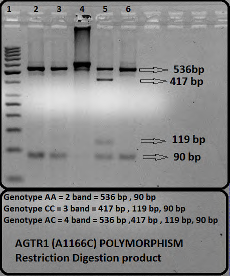 Figure 1: Ethedium bromide stained 2.5% agarose gel shows digested products for AGTR1 A1166C polymorphism(rs5186) by HpyF3I (DdeI) restriction enzyme . Fragments for allele ‘A’ = 536 bp and 90 bp ; allele ‘C ‘= 417 bp, 119 bp, and 90bp. Lane 1: DNA marker.; Lane 2,3,6 : Genotype AA : 2 Fragments of 536 bp and 90 bp ; Lane 4: Undigested PCR product ; Lane 5: Genotype AC : 4 fragments of 536 bp, 417 bp , 119 bp and 90 bp.