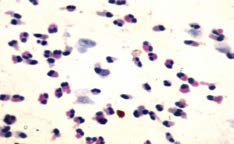 Figure 2: Nasal smear shows plenty of eosinophils & few columnar epithelial cells (Grade IV) [MGG Stain; X 100].