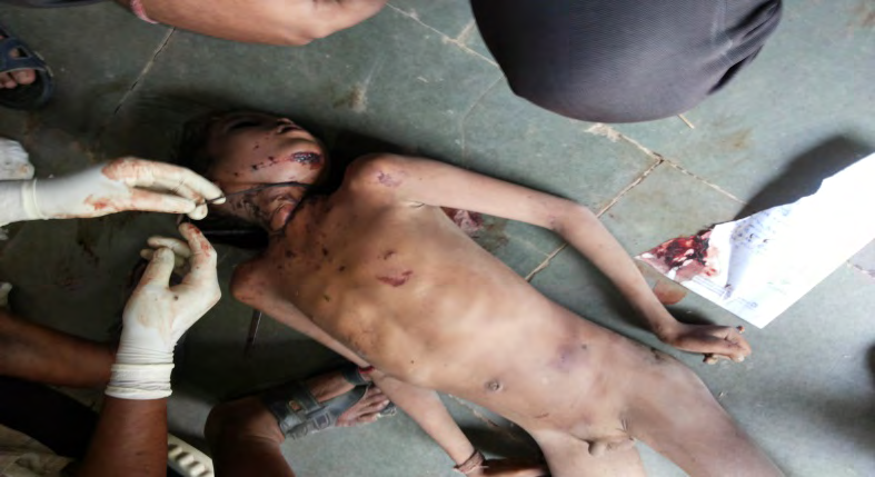 Figure 2: Findings of neck and face suggestive of strangulation.