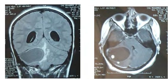 Figure 2: Injected T1 brain MRI (a) showing 49 mm diameter right cerebellar tumor process with a hypo- intense cyst and a hypersignal tissue portion. Cerebral MRI flair (b) showing a large right cerebellar tumor process associated with peri-lesional edema described in T2 hypersignal.