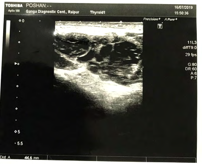 Figure 1: Left supraclavicular swelling shown with arrow.