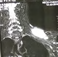 Figure 2: Ultrasonographic image of neck showing heterogenous hypoechoic lesion.