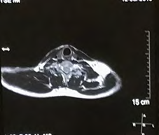 Figure 3: ** Contrast magnetic resonance imaging of neck images.