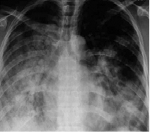 Figure 3: 29 years old with H1N1 with high inflammation in the lungs and respiratory systems.
