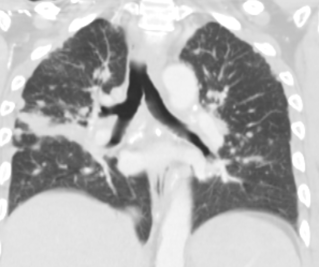Figure 2: Multiple pleural-based nodules and pleural thickening, thickening of the inter-lobar fissure on the right side and multiple calcified mediastinal lymph nodes.