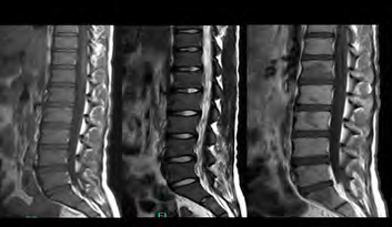 Figure 5: MRI lumbosacral spine images showing areas of non-enhancement in multilevel vertebral bodies, seen on post contrast image (c), these abnormal areas are isointense on non-contrast T1 and T2 images.