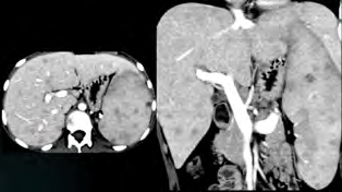 Figure 6: Axial and coronal CT abdomen post-contrast images showing hepatosplenomegaly with multiple hypodense areas of varying sizes are in both lobes of liver and spleen.
