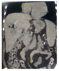 Figure 1: Arrow showing the emphysematous suppuration of the liver.