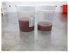 Figure 3: The toffee coloured pus aspirated from liver.